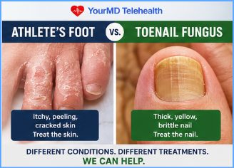 Athlete's Foot or Toenail Fungus? How to Tell the Difference